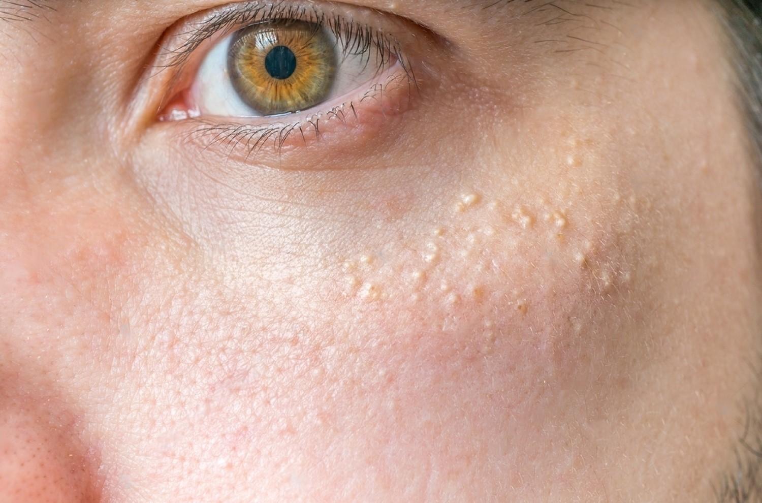 How Can You Fix Bumps Under the Eyes?